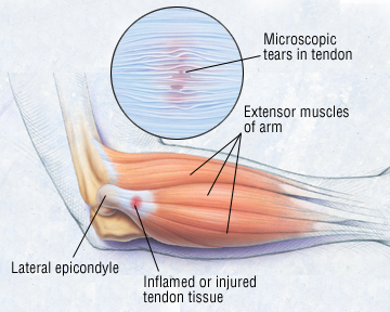 Lateral Epicondylitis (Tennis) | Treatment And ... the muscles around knee diagram 